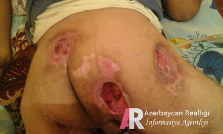 Aprel döyüşçümüz acınacaqlı vəziyyətdə: 