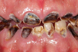 Hər gün qazlı su içən kişinin dişləri bu hala düşdü - FOTO