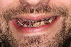 Hər gün qazlı su içən kişinin dişləri bu hala düşdü - FOTO