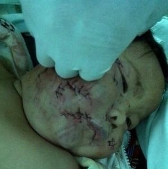 Ana övladına qida verən zaman üzünü qayçı ilə 90 dəfə kəsib