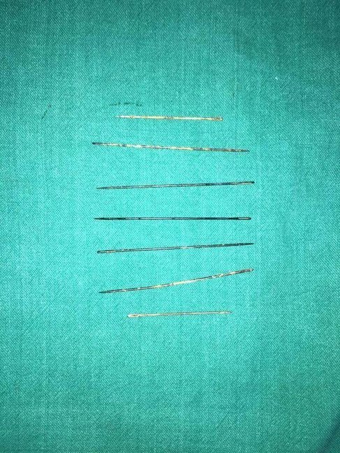 3 yaşlı qızın rentgen kağızı həkimləri dəhşətə gətirdi - FOTOLAR