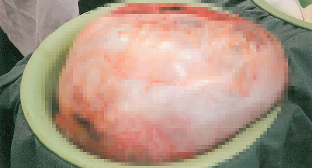 16 yaşlı qızın qarnı şişməyə başladı - Hamı hamilə olduğunu düşünsə də…/FOTO