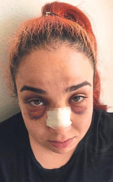 Müdir işdə telefonla danışan Zeynəbi süpürgəylə DÖYÜB BU HALA SALDI - FOTO