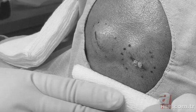 Başındakı şişə görə həkimə getdi, nəticədən şoka düşdü - FOTOLAR