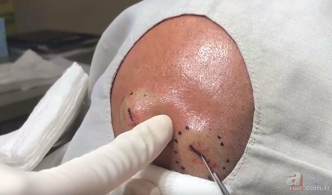 Başındakı şişə görə həkimə getdi, nəticədən şoka düşdü - FOTOLAR