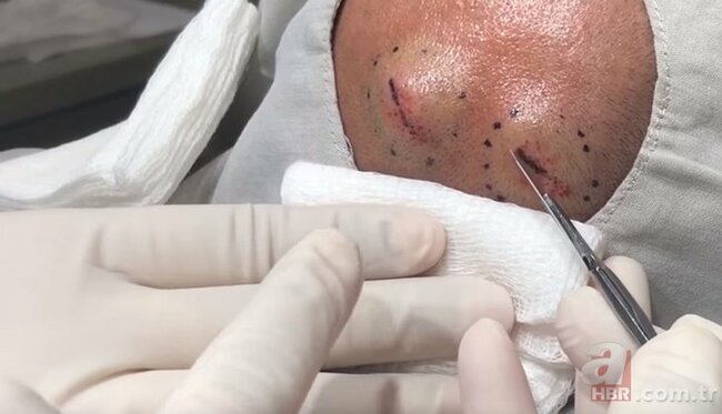 Başındakı şişə görə həkimə getdi, nəticədən şoka düşdü - FOTOLAR