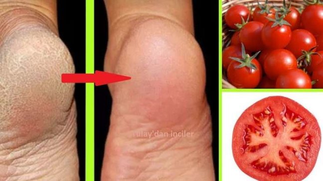 Pomidor ilə daban çatına SON - VİDEO