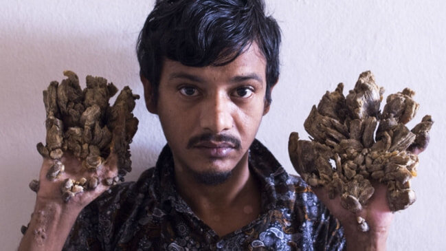 Dünyada nadir yayıılan xəstəlikdən əziyyət çəkir: 