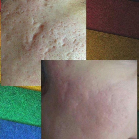 Üzdəki çapıqlardan necə qurtulmalı? - MÜALİCƏ ÜSULLARI