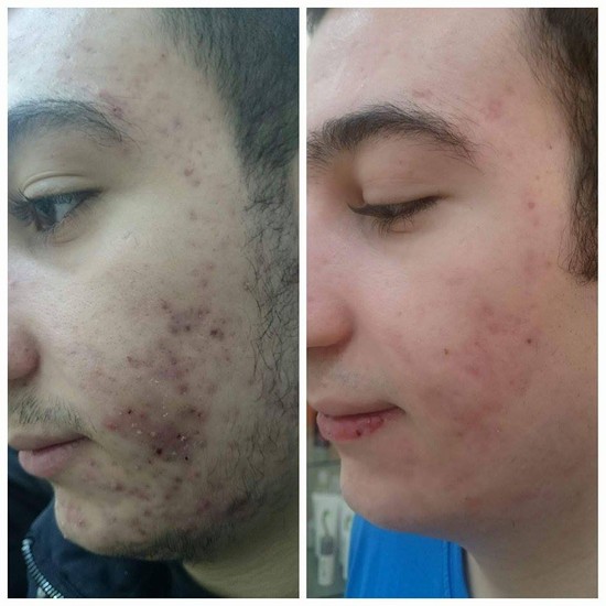 Üzdəki çapıqlardan necə qurtulmalı? - MÜALİCƏ ÜSULLARI