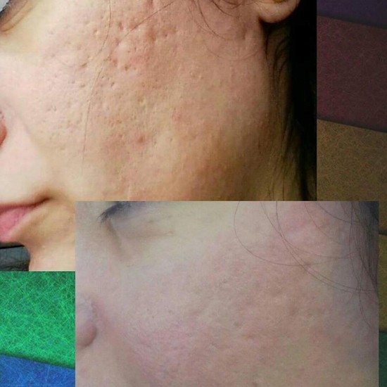 Üzdəki çapıqlardan necə qurtulmalı? - MÜALİCƏ ÜSULLARI