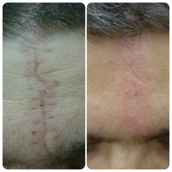 Üzdəki çapıqlardan necə qurtulmalı? - MÜALİCƏ ÜSULLARI