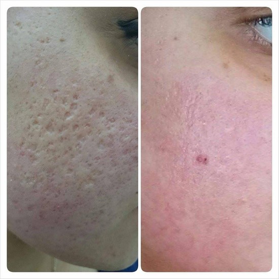 Üzdəki çapıqlardan necə qurtulmalı? - MÜALİCƏ ÜSULLARI