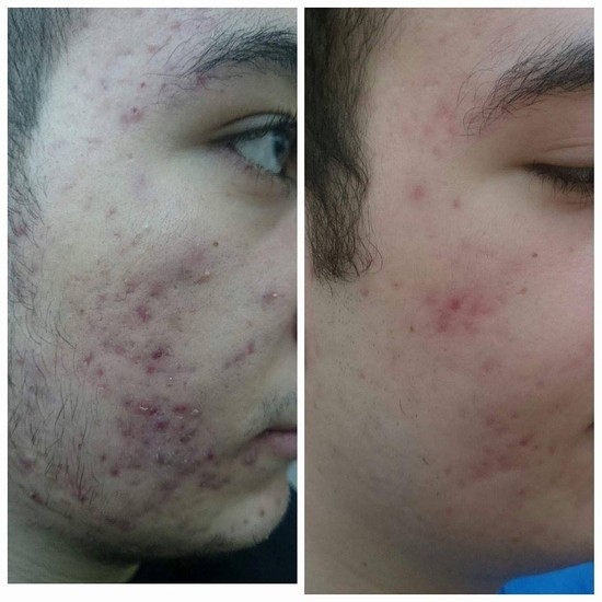 Üzdəki çapıqlardan necə qurtulmalı? - MÜALİCƏ ÜSULLARI