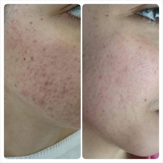 Üzdəki çapıqlardan necə qurtulmalı? - MÜALİCƏ ÜSULLARI