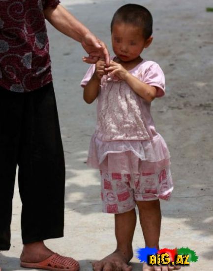 3 Yaşında Yu Yu-nun ayaqları dayanmadan böyüyür (Fotolar)