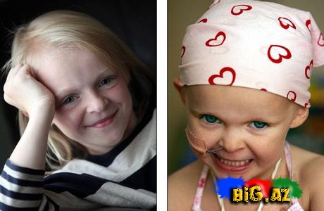 9 yaşında 2 dəfə xərçəngə qalib gəldi- FOTO