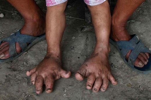 3 yaşlı uşağın ayaqları görənləri şoka saldı - FOTO