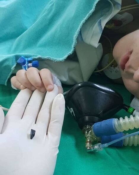 Azərbaycanda azyaşlı oyuncaq parçası uddu: Həyati təhlükə ilə üzləşdi - FOTO