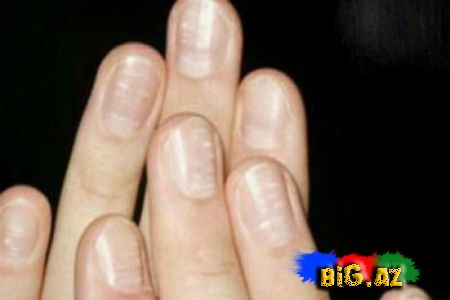 Dırnaqda niyə bəyaz ləkələr yaranır?