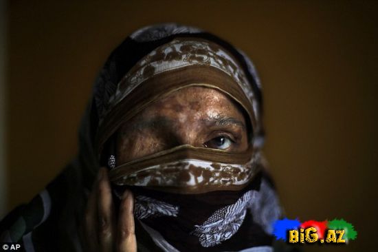 Hindistanda "kislota" qanunu qəbul edildi - FOTO