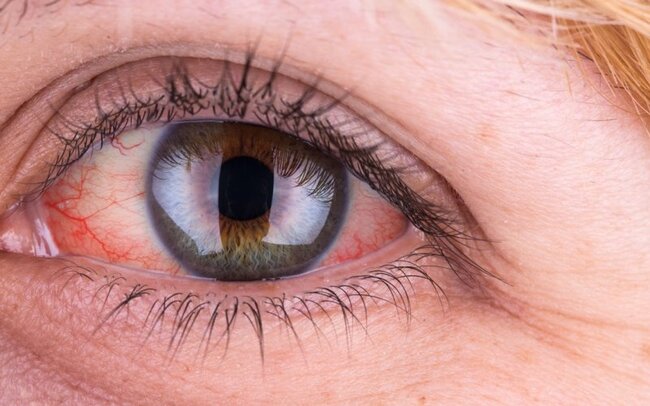 Göz qızartısının səbəbi nədir? – BU XƏSTƏLİKLƏRİN XƏBƏRÇİSİDİR