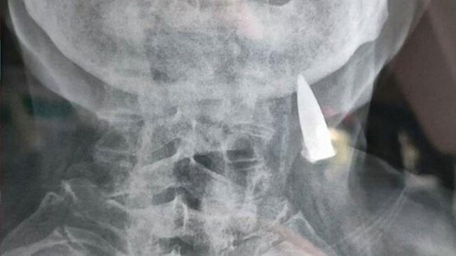 Baş ağrısı şikayəti ilə həkimə gedən 95 yaşlı kişinin rentgen nəticələri həkimləri şoka saldı