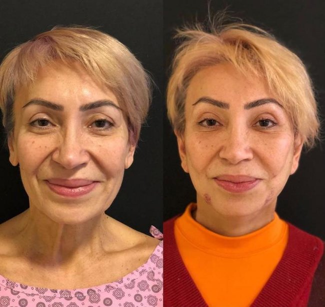57 yaşlı Əməkdar artistin plastik əməmliyyatdan sonrakı halı - Fotolar