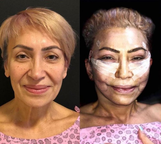 57 yaşlı Əməkdar artistin plastik əməmliyyatdan sonrakı halı - Fotolar