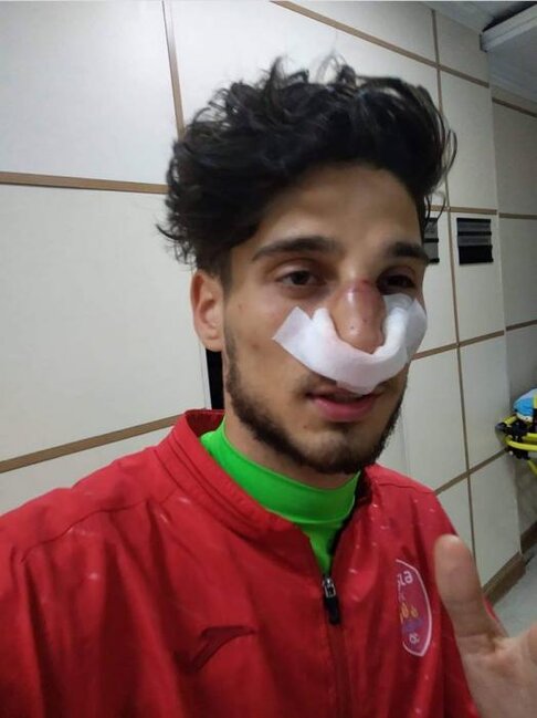 Azərbaycanlı prodüserin oğlu qapıçının burnunu sındırdı - Foto