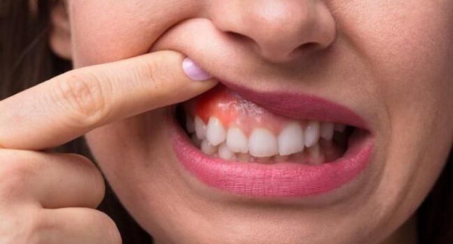 Diş ətiniz qanayırsa, bu vitamin çatışmır