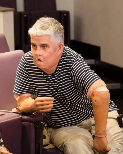 3 ay komada qaldıqdan sonra ayıldı, qolları, əlləri və üzünün kəsildiyini gördü - şok