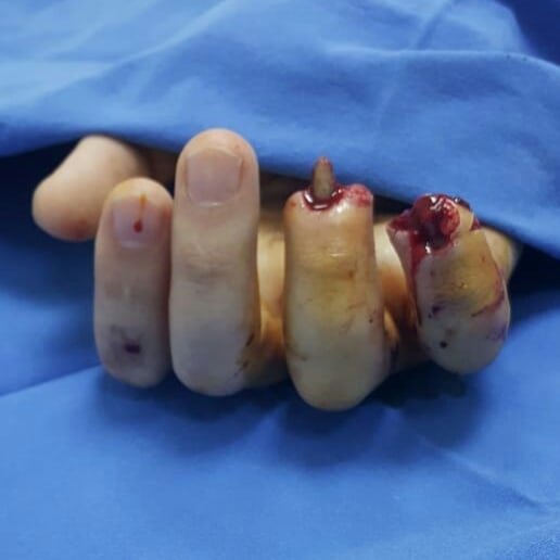 Bakıda əlində pirotexniki vasitə partladı… - Ürəyi zəiflər baxmasın/Fotolar