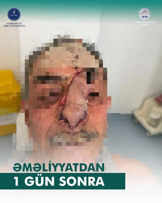 İt dişləməsi nəticəsində burnunu itirən xəstəyə yeni burun formalaşdırıldı - Azərbaycanda unikal əməliyyat