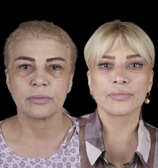 Mətanət İsgəndərli əməliyyatla belə dəyişdi - Fotolar