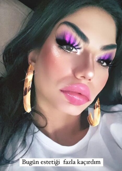 Demetdən estetik iddialarına cavab - Foto