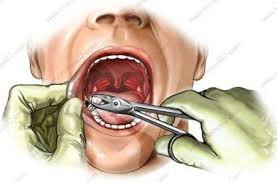 Əskik dişlər beynin kiçilməsinə səbəb olur