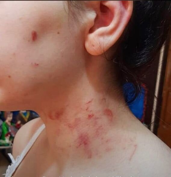 Uşaq sığınacağından anasının yanına dönən 15 yaşlı qız növbəti dəfə bədənində xəsarətlərlə evdən qaçıb - FOTO