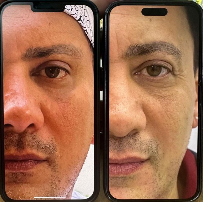 Sərxan plastik əməliyyatdan sonra - Foto