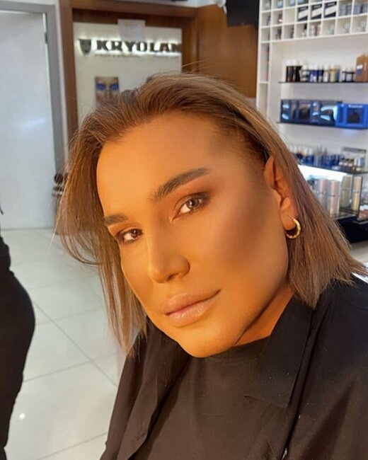 Samir Bağırov plastik əməliyyatdan sonra - Fotolar