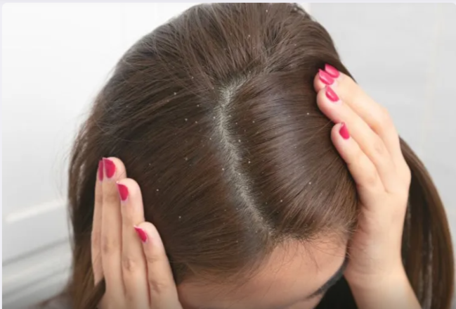 Kəpəkdən həmişəlik xilas olmağın yolu - 2 təsirli üsul