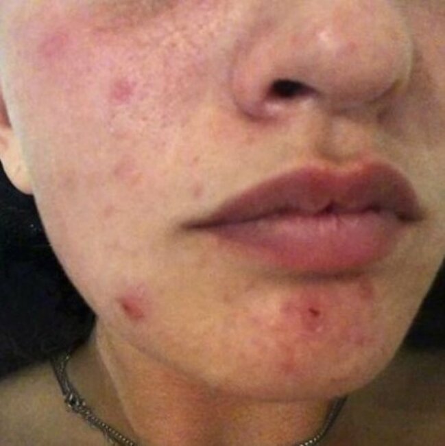 Üzündə ləkələr yaranan 29 yaşlı qadın həkimə getdi, eşitdiklərindən şoka düşdü - FOTOLAR