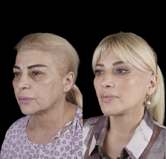 Mətanət İsgəndərli əməliyyatla belə dəyişdi - Fotolar