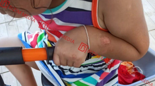 Lənkəranda qandonduran HADİSƏ – Ana isti qaşıqla 3 yaşlı qızının qolunu DAĞLADI