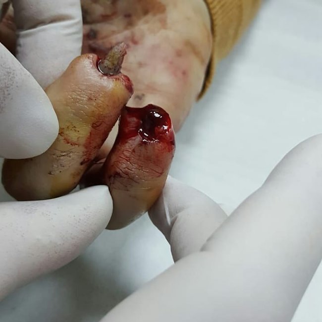 Bakıda əlində pirotexniki vasitə partladı… - Ürəyi zəiflər baxmasın/Fotolar