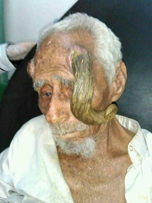 130 yaşlı qoca "buynuz" əməliyyatından sonra ÖLDÜ - FOTO