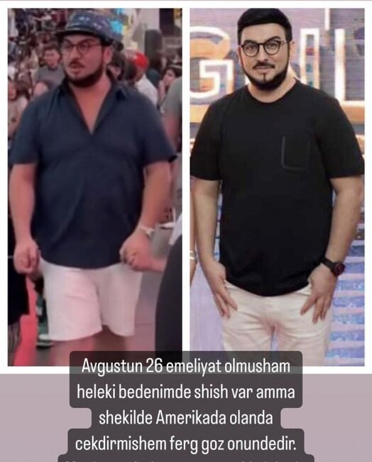 Tolik plastik əməliyyatdan sonra - Foto