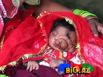 İki üzlü qız doğuldu - FOTO-VİDEO