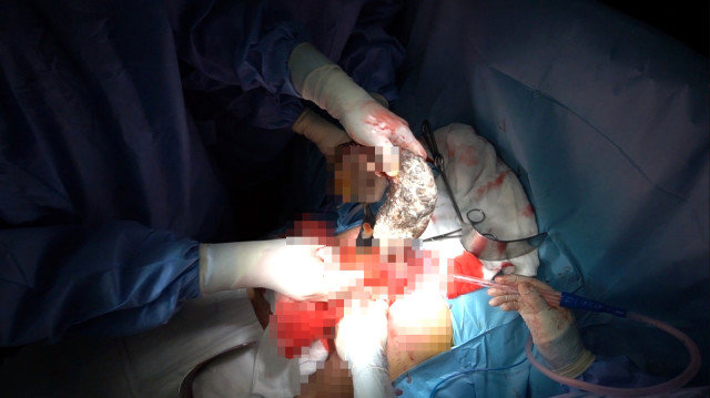 11 yaşlı qızın mədəsindən çıxanlar həkimləri şok etdi - FOTOLAR