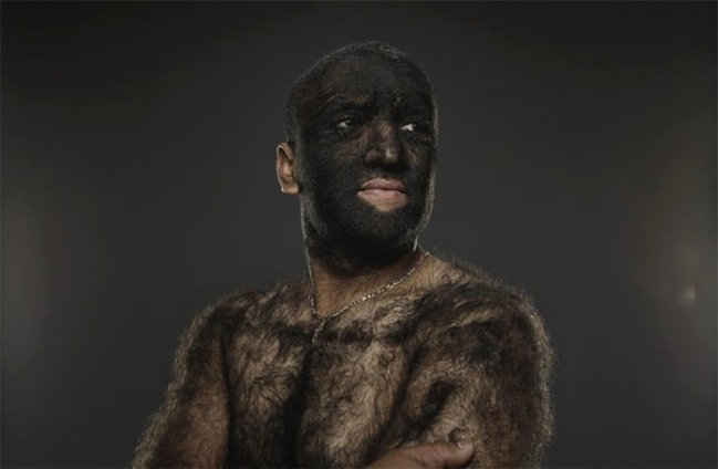 Dünyanın ən tüklü insanı - Hamı ondan danışır - FOTOLAR